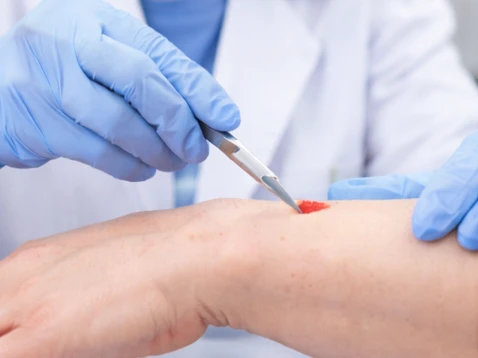 Imagem ilustrativa de biópsia dermatológica