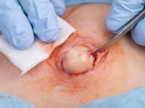 Retirada de Cistos e Lipomas