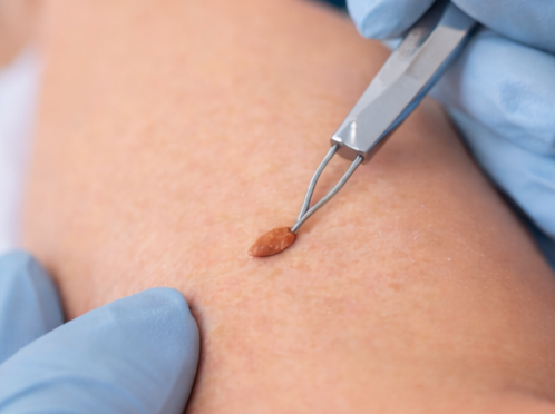 Retirada de Sinais e Lesões de Pele